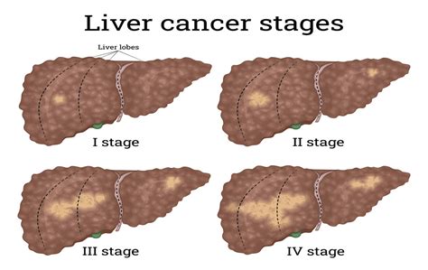 liver cancer near rocklin|End stage liver cancer: Symptoms timeline and life .